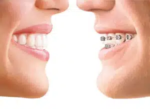 Split image comparing a smiling person with straight teeth to a person wearing metal braces