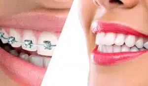 Side-by-side comparison of teeth with braces and a smile with veneers
