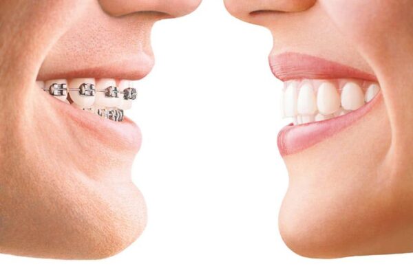 Braces vs Veneers: Which Option Is Better for Your Smile Goals?