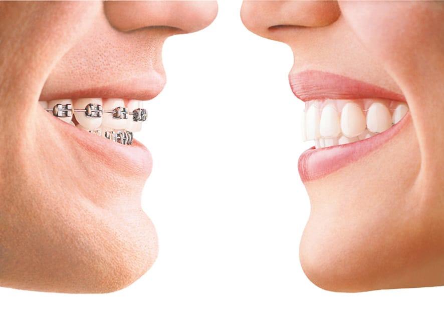 braces vs veneers