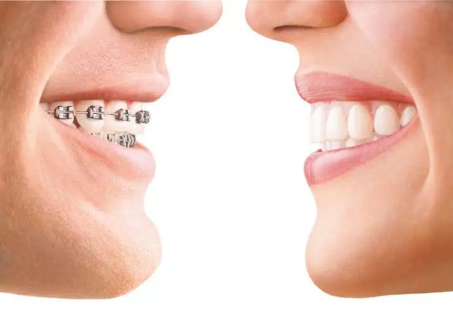 braces vs veneers