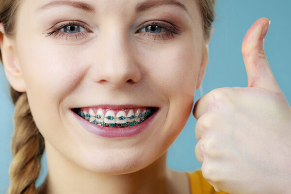 Signs You May Need Braces (Even as an Adult)