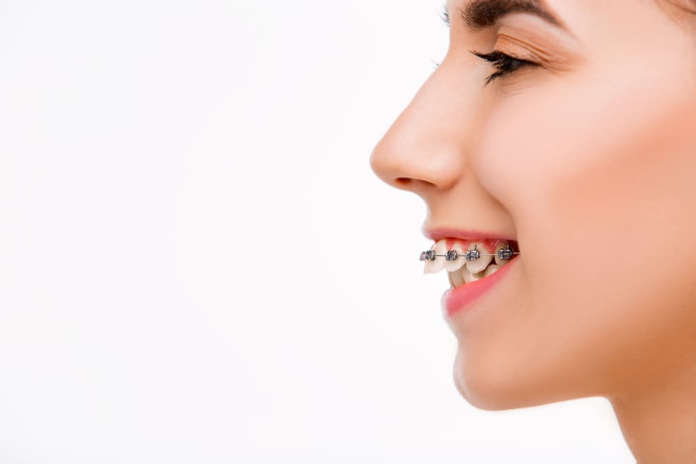 Profile view of a smiling young woman wearing clear ceramic braces, showcasing orthodontic treatment options available at Zaidi Orthodontics in Rocky Hill, CT.