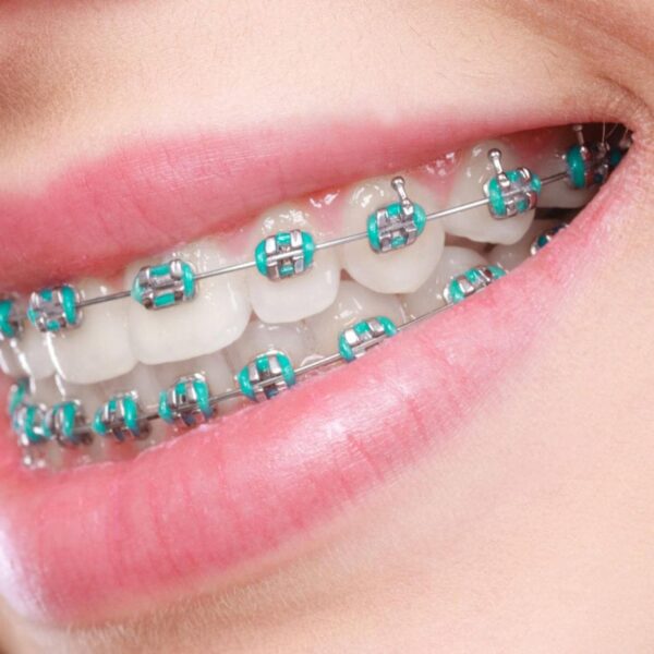 Close-up of a smiling mouth with traditional metal braces featuring turquoise-colored brackets, highlighting orthodontic treatment for teeth straightening.