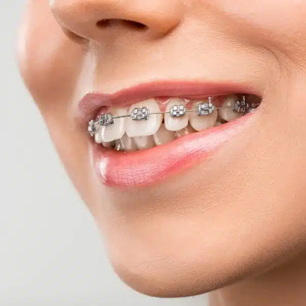 Close-up of a smiling person wearing metal braces in Simsbury