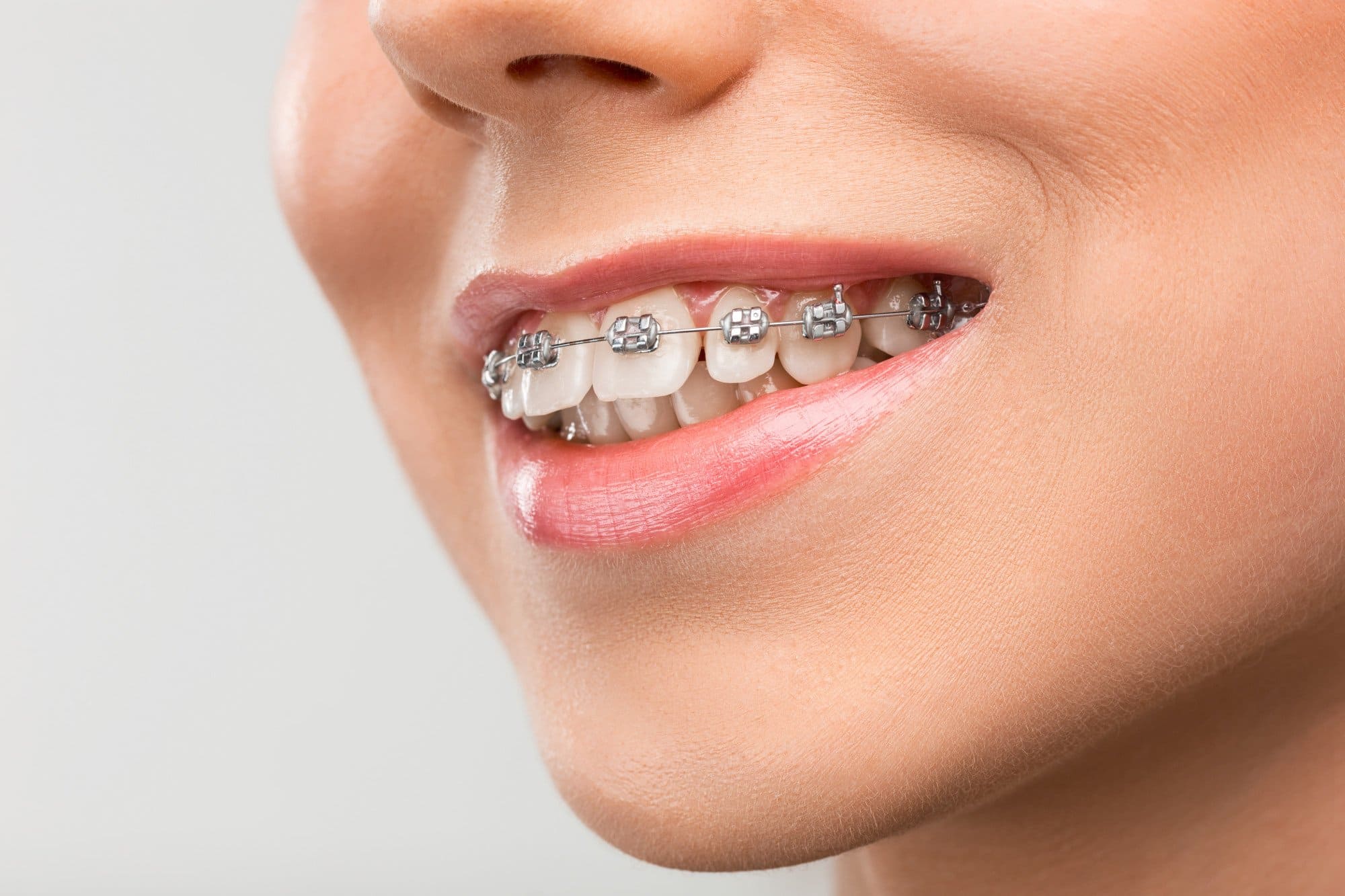 Close-up of a smiling person wearing metal braces, showcasing a straightened smile, emphasizing orthodontic treatment benefits for improved dental health and aesthetics.