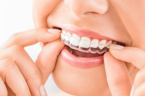 Your First Week With Invisalign: What to Expect