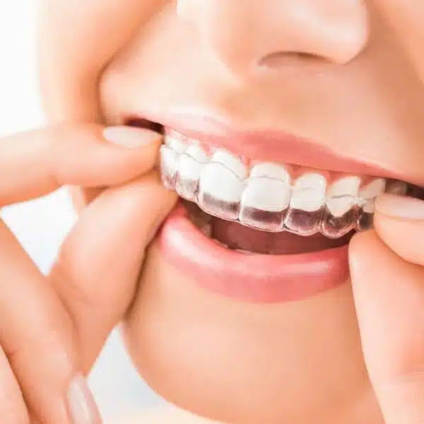 Close-up of a hand placing a clear Invisalign aligner onto teeth