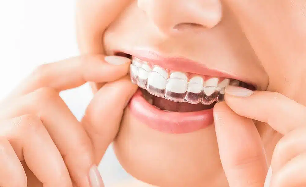 Close-up of a hand placing a clear Invisalign aligner onto teeth