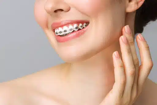 Smiling woman showing off her ceramic braces