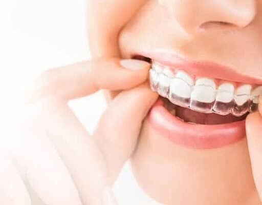 Types of Braces Cost Comparison: Most Affordable Braces Options Explained