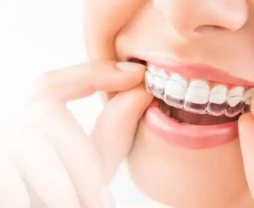 Comparison of clear aligners and traditional braces with cost information