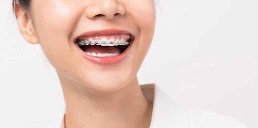 How to Make Braces Affordable in Connecticut