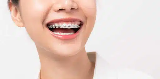 Smiling young woman wearing metal braces
