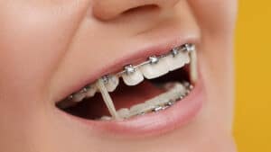 different types of braces for teeth